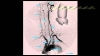 Ψηφιακή Αφαιρετική Αγγειογραφία DSA Αορτικού Τόξου [upl. by Narik254]