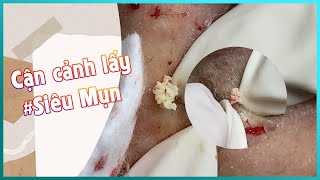 Big Cystic Acne Blackheads Extraction Blackheads amp Milia Whiteheads Removal Pimple Popping [upl. by Alis]