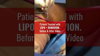 Amazing Patient Results after Liposuction amp Renuvion [upl. by Emili]