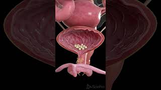 🪨 Bladder Stones What You Need to Know 🪨 anatomy [upl. by Cathyleen]