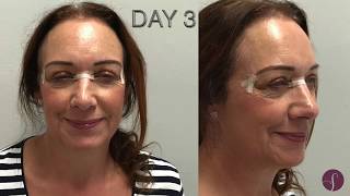 Eyelid Surgery Blepharoplasty LIVE SURGERY Before and After [upl. by Alyahsal379]