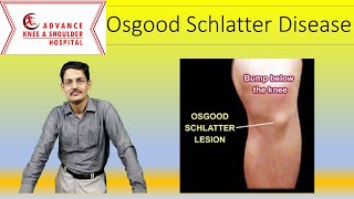 Osgood schlatter Disease [upl. by Undine]