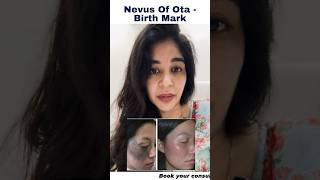 Dermatologist Dr Anvika Reveals The Solution Of Nevus Of Ota [upl. by Alius]