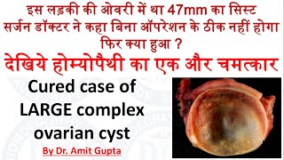 Complex Ovarian Cyst cured case Large Hemorrhagic Cyst complication of complex ovarian cyst [upl. by Adniroc311]