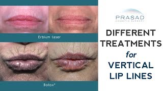 How Vertical Lip Lines Lip Wrinkles can be Treated With Minimal to No Downtime [upl. by Mogerly]