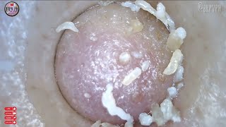 Rain  Blackhead Removal  brpvph pimple acne blackheads [upl. by Ednutabab]