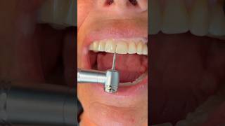 Reshaping Worn  Chipped Teeth After Braces Or Invisalign [upl. by Enitsahc]