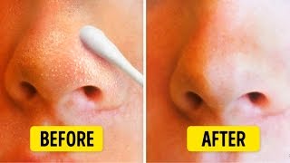 9 Natural Ways to Get Rid of Blackheads on Nose [upl. by Scrogan]