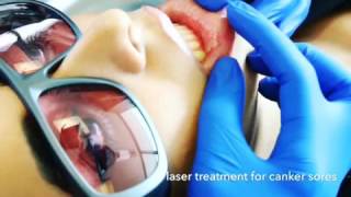 Laser Therapy for Canker Sores aka Aphthous Ulcers [upl. by Kyriako]