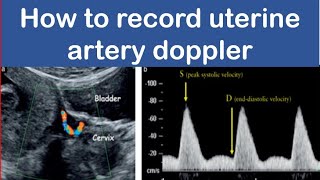 How to record uterine artery doppler [upl. by Ailadi656]