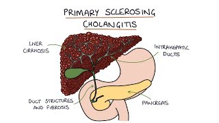 Primary Sclerosing Cholangitis Visual Explanation for Students [upl. by Debbee764]