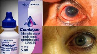 Combigan Eye Drop For Ocular Hypertension glaucoma  Brimonidine  Timolo [upl. by Dibbell]