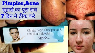 Clinsol gel for pimples [upl. by Ycrep]