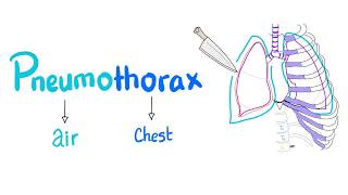 Pneumothorax  Spontaneous vs Tension Pneumothorax  Lung Physiology  Pulmonary Medicine [upl. by Malinde]