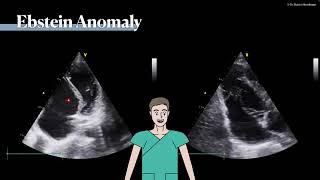 〖Echocardiography〗 Ebstein anomaly 💘 [upl. by Kobi]