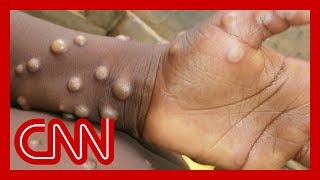 Monkeypox  how does it spread and what are the symptoms [upl. by Zakarias]