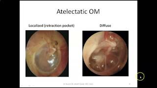 Chronic Non Suppurative Otitis Media 2 Atelectatic Adhesive OM and Tympanosclerosis [upl. by Mayyahk]