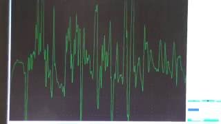 Myopathy EMG changes explained [upl. by Fidel]