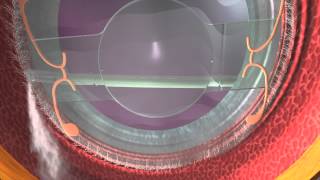 Miyake View of Dropless™ Cataract Surgery [upl. by Herson]