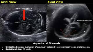 Fetal Brain Ultrasound Reporting  Obstetric Brain Pathologies Scan Reports  Pregnancy USG [upl. by Rubin]