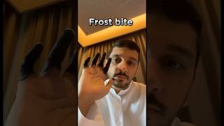 Frost bite 🥶 Explained fahadbadar2 telugu interstingfactsintelugu telugufacts [upl. by Demetris916]