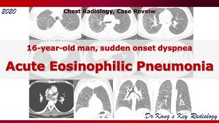 Acute Eosinophilic Pneumonia Case Review [upl. by Asina]