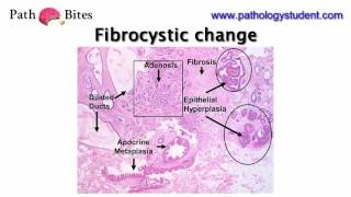 Path Bites  Fibrocystic change [upl. by Ahgiel]