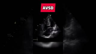 Atrioventricular septal defect  congenital heart defect echocardiography AVSD [upl. by Asenad74]