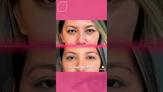 Você faria BLEFAROPLASTIA BLEFAROPLASTIA estetica procedimentoestético [upl. by Sessilu]