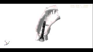 Medtronic CoreValve simulation [upl. by Artemed111]