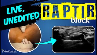 RAPTIR block start to finish Retroclavicular Approach to the Infraclavicular Region [upl. by Kinom]