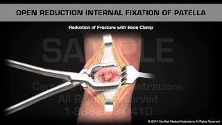 Open Reduction Internal Fixation of Patella [upl. by Zzabahs]