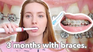 BRACES  3 month update  dental routine [upl. by Isbella]