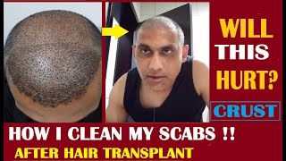 How To Remove Scabs amp Heal Donor Area After Hair Transplant Surgery [upl. by Ldnek]