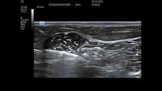 Paediatric popliteal block [upl. by Lamak641]