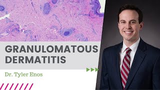 Granulomatous Dermatitis  May 2022 \ Dermpath Happy Hour [upl. by Aidan]