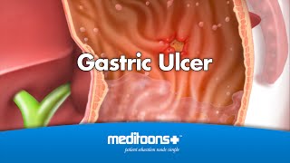 Gastric Ulcer  Meditoons™ [upl. by Hallette]