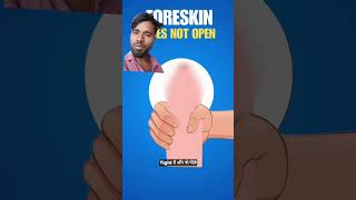 Testicle specialist trending circumcision review [upl. by Yenahteb]