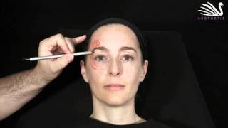 4  Eyebrowlift mit Botox  Dr Günther [upl. by Secnirp]