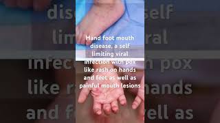 Hand foot mouth disease baby virus rash fever [upl. by Cristionna]