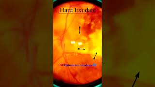 Diabetic retinopathy  Hemorrhages  Hard exudates  Fundus  Short Video 188 [upl. by Ibmab]