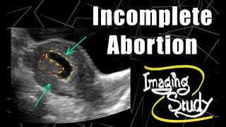 Incomplete Abortion  RPOC  Ultrasound  Case 166 [upl. by Namrak354]