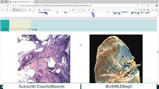 Chp13 Robbins Patho  Lung Pathology  Coal Worker Pneumoconiosis  Restrictive Lung Disorders [upl. by Sayre]