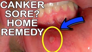 How To Get Rid Of Canker Sores Mouth Ulcer Home Remedy [upl. by Anaoj810]