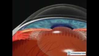 GLAUCOMA DE ANGULO CERRADO E IRIDOTOMIA LASER [upl. by Laureen]