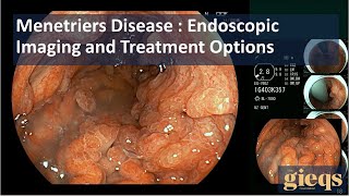 Menetriers Disease  Endoscopic Imaging and Treatment Options [upl. by Barris]