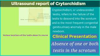 ultrasound report of Cryptorchidism Cryptorchidism pathology ultrasound [upl. by Oicnerual]