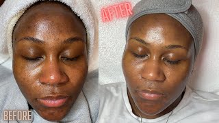 Hyperpigmentation Correction w Microdermabrasion [upl. by Carr]