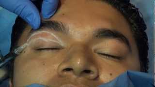 chemical right upper blepharoplasty with endopeel technique [upl. by Aserehtairam22]