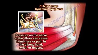 Cubital Tunnel Syndrome  Everything You Need To Know  Dr Nabil Ebraheim [upl. by Ecila439]